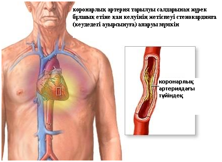 Stenokz